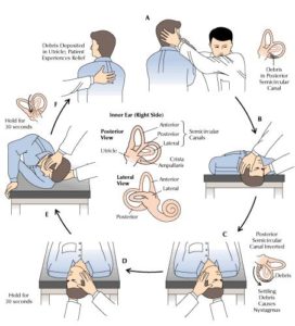 positional vertigo