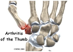 cmc arthritis