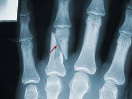 finger fracture